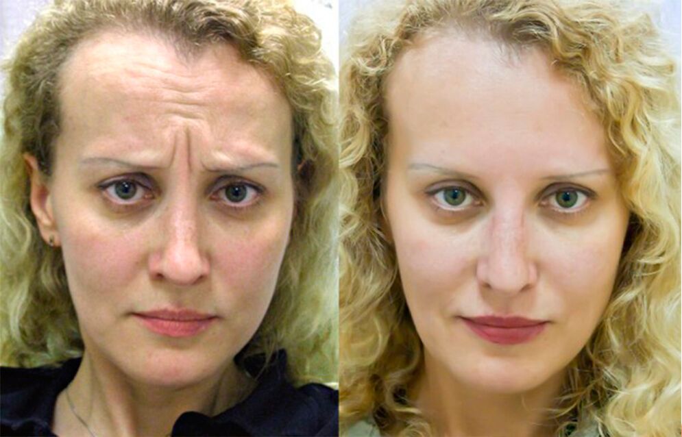 antes e despois de usar o masaxe para o rexuvenecemento ltza foto 1