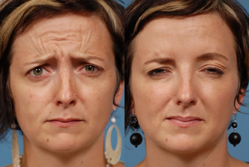 antes e despois de usar o masaxe para o rexuvenecemento ltza foto 2