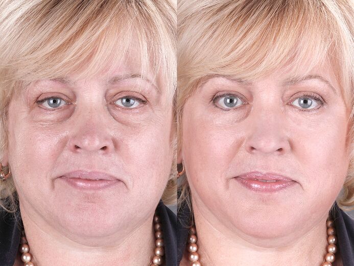 antes e despois de usar o masaxe para o rexuvenecemento ltza foto 3