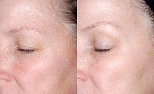 Rexuvenecemento da pel arredor dos ollos antes e despois das fotos