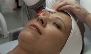 Blefaroplastia para rexuvenecer a pel arredor dos ollos